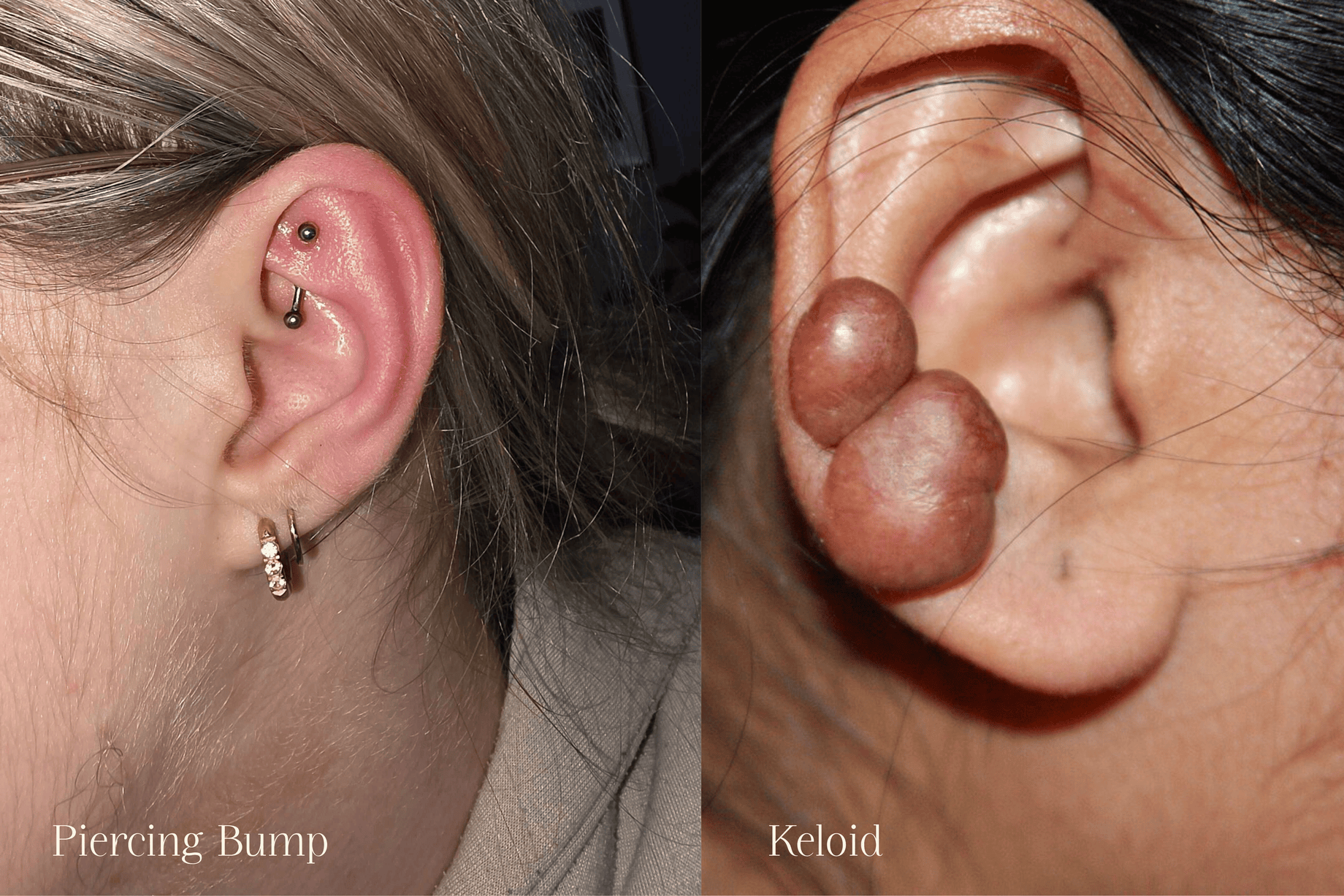 Piercing Bump vs Keloid: How to Tell the Difference