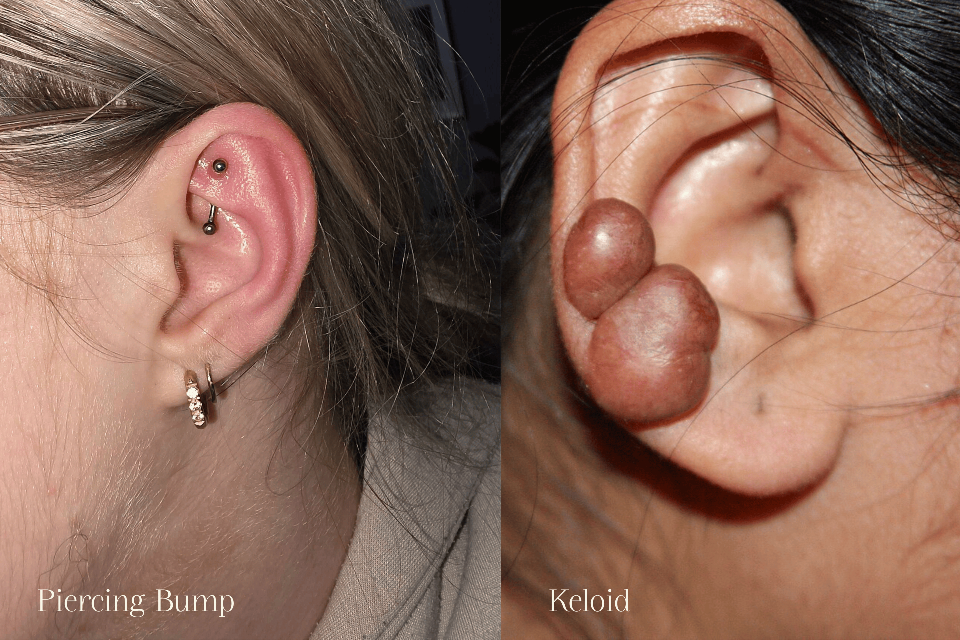 Piercing Bump vs Keloid: How to Tell the Difference